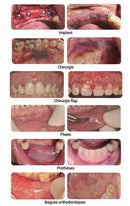 MATBEKA intra-oral boîte 20 pansements XL (50x15mm) - Safe Implant